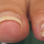 皮膚科医が教える正しい爪の切り方…その切り方危険かもしれません…