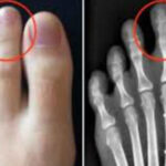 足の人差し指が親指より長い人は要注意…特に子供の場合こんな危険が…