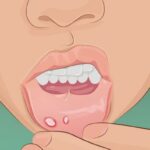 唇が教えてくれる体の状態8選…唇が乾燥したり吹き出物がでたりするのはなぜ？